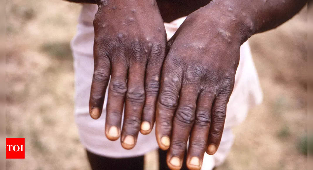 Take even 1 case as an outbreak: Government’s guideline on monkeypox | India News